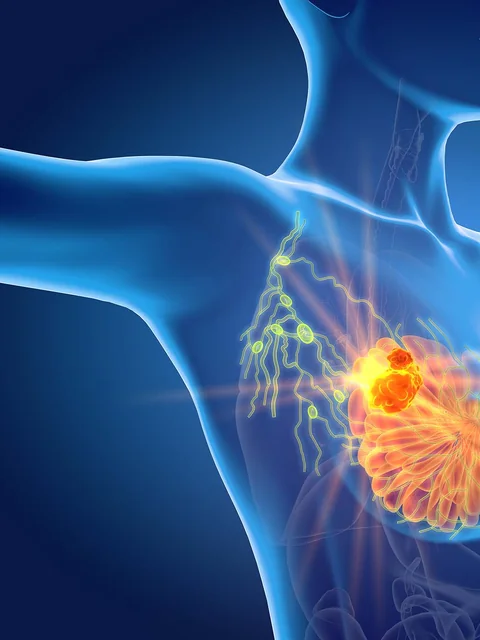 Understanding Breast Cancer cover