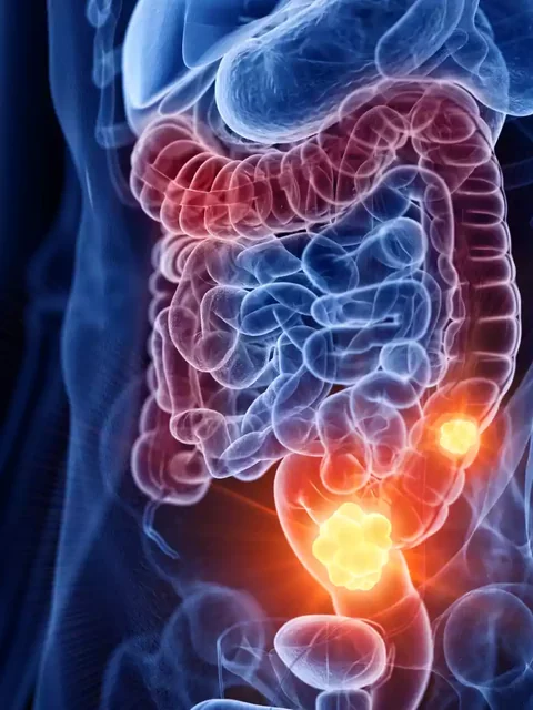 Understanding and Managing Colon Cancer cover