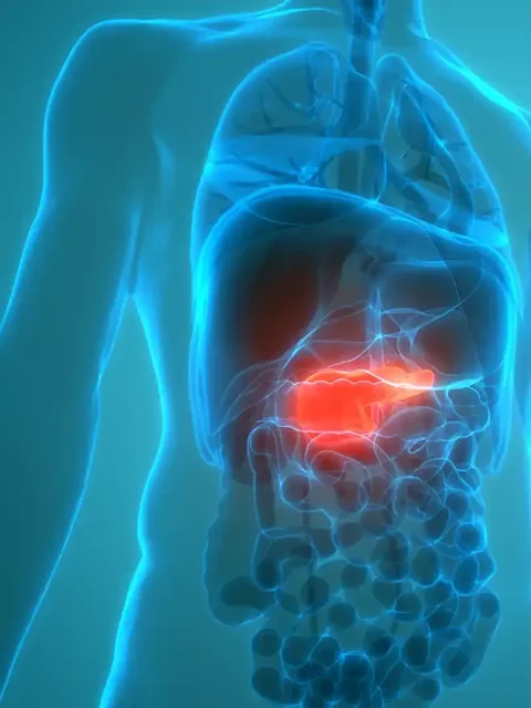 Pancreatic Cancer cover