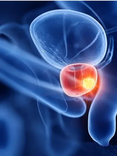 Prostate Cancer cover
