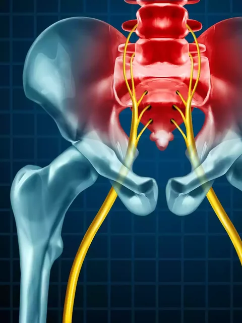 Overcoming Sciatica Pain cover