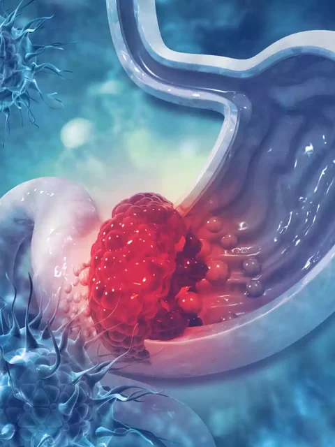 Stomach Cancer: A Comprehensive Guide cover